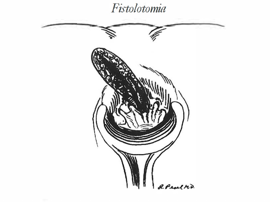 Fistolotomia